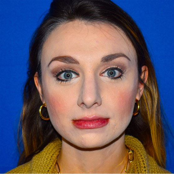 Patient 34, view 1 view after rhinoplasty