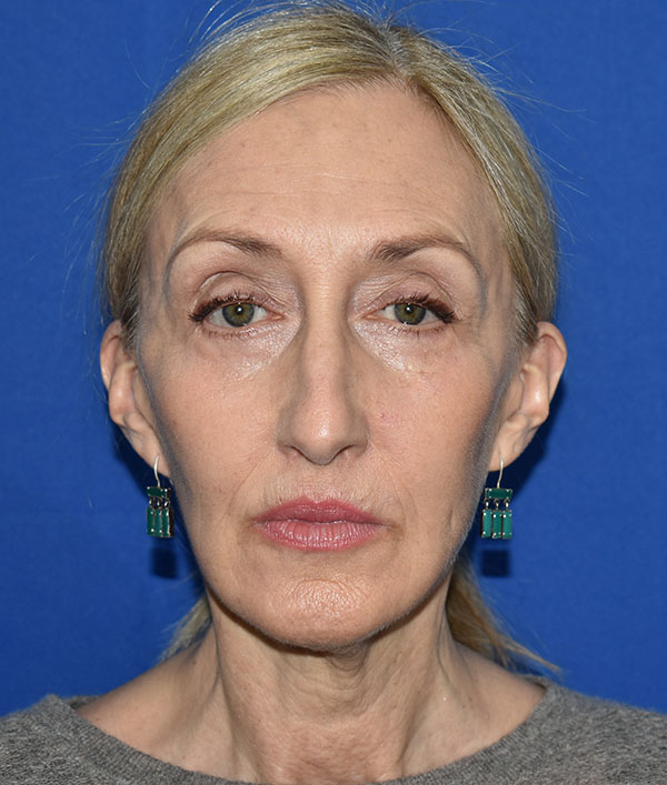 Patient 07, view 1 view before facial fat grafting