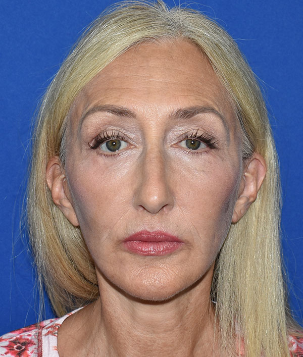 Patient 29, view 1 view after facelift