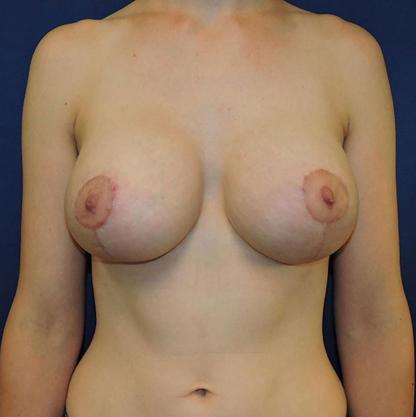 Patient 51, view 1 view after breast augmentation with lift