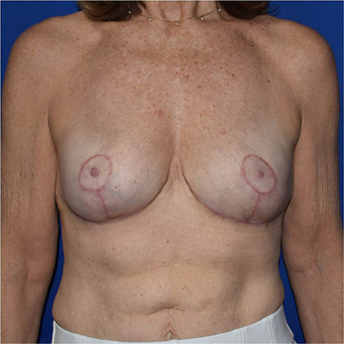 Patient 14, view 1 view after implant removal
