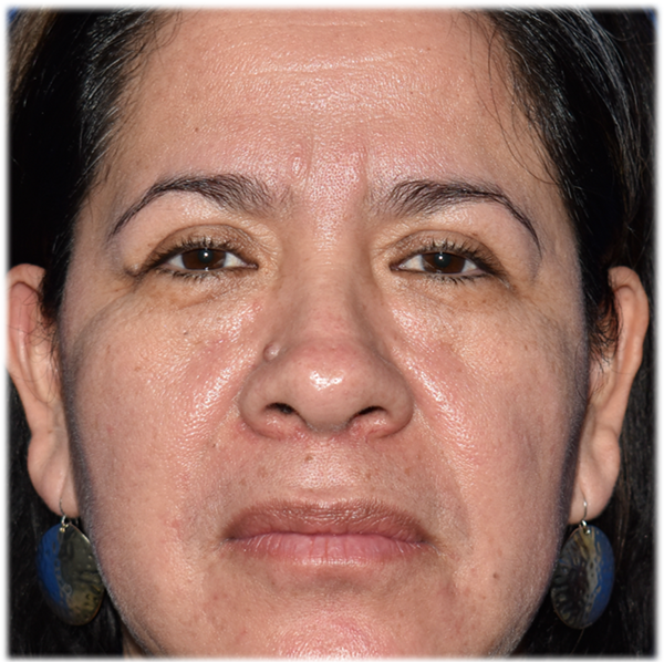 Patient 17, view 1 view before blepharoplasty