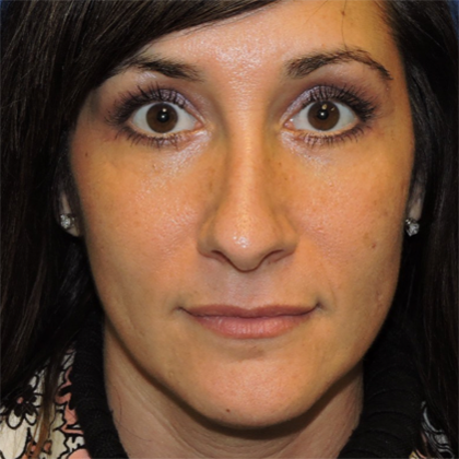 Patient 10, view 1 view after blepharoplasty