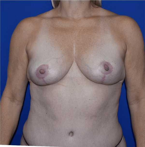 Patient 20, view 1 view after breast lift