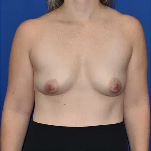 Patient 20, front view before breast augmentation