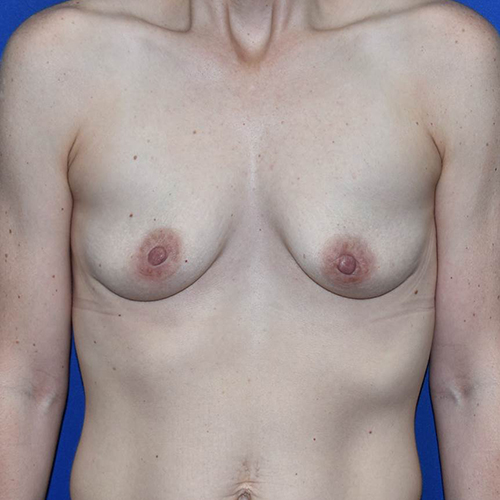 Patient 69, view 1 view before breast augmentation