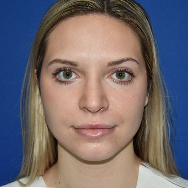 Patient 07, view 1 view after rhinoplasty
