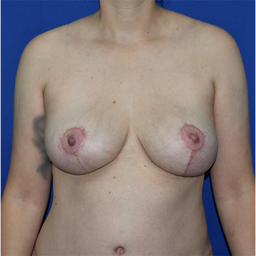 Patient 07, view 1 view after breast lift