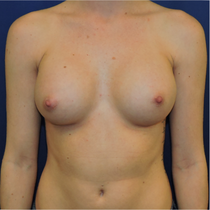 Patient 09, view 1 view after mini breast augmentation
