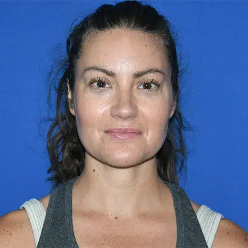 Patient 12, front view after chin liposuction