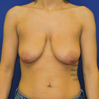 Patient 41, view 1 view before breast augmentation with lift