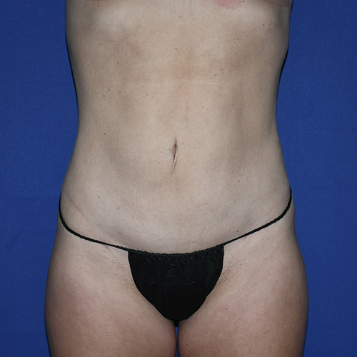 Patient 13, front view after liposuction