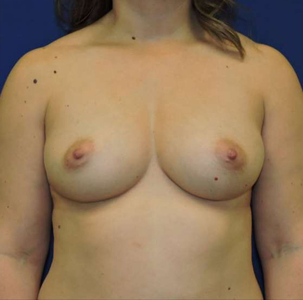 Patient 112, view 1 view before breast augmentation