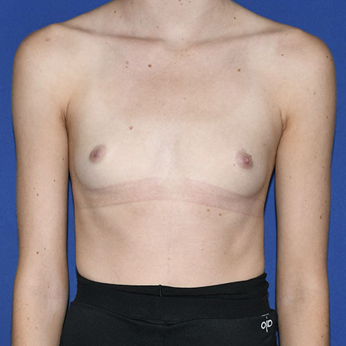 Patient 04, front view before mini breast augmentation