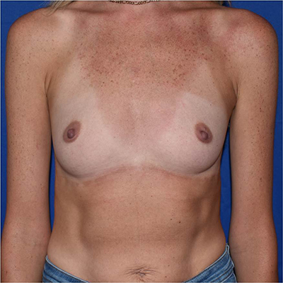 Patient 18, view 1 view before breast augmentation