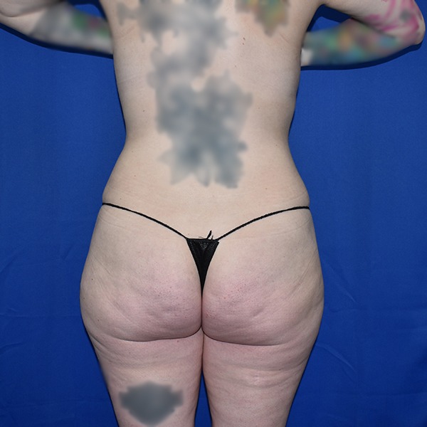 Patient 03, view 1 view after brazilian butt lift