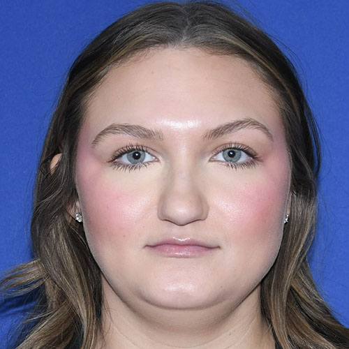 Patient 38, front view before rhinoplasty