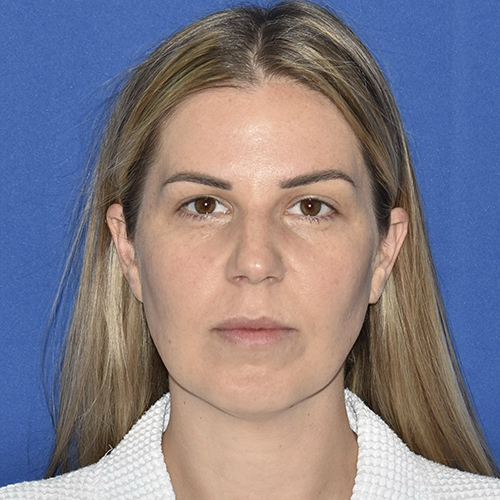 Patient 08, front view before chin augmentation