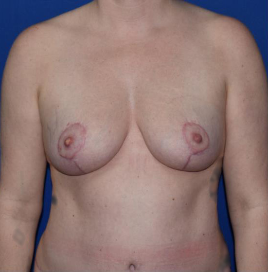 Patient 11, view 1 view after breast lift