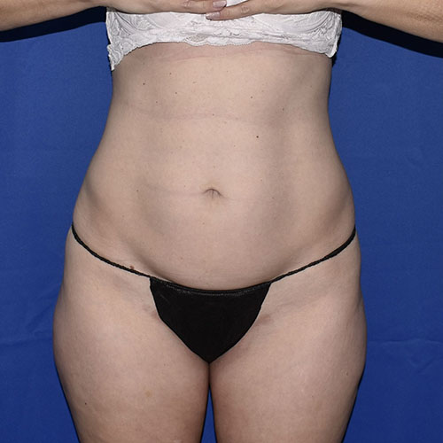 Patient 15, front view before tummy tuck