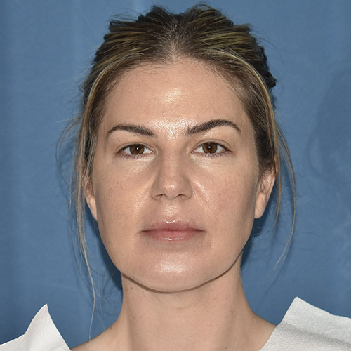 Patient 08, front view after chin augmentation