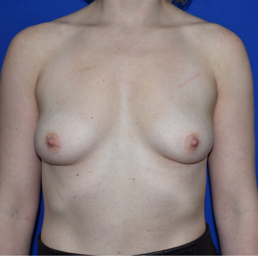 Patient 99, view 1 view before breast augmentation