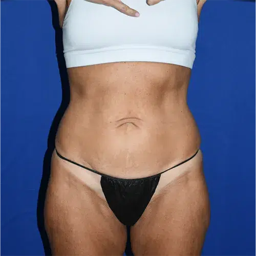 Patient 28, front view before tummy tuck