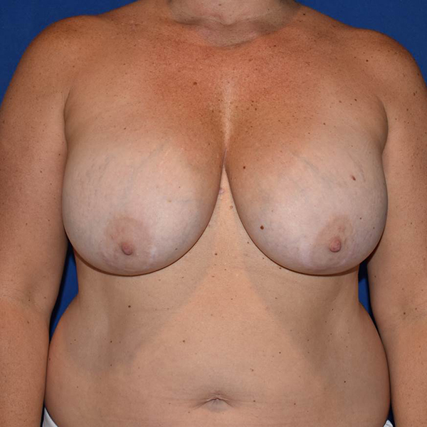 Patient 26, view 1 view before breast lift