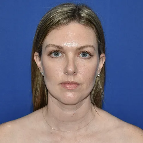 Patient 11, front view after rhinoplasty