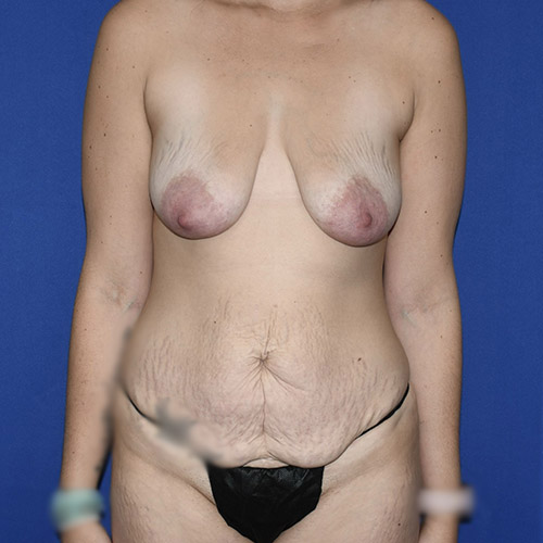 Patient 10, front view before breast lift