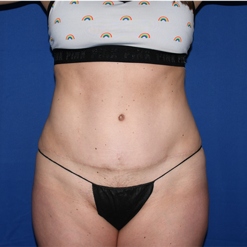 Patient 01, front view after tummy tuck