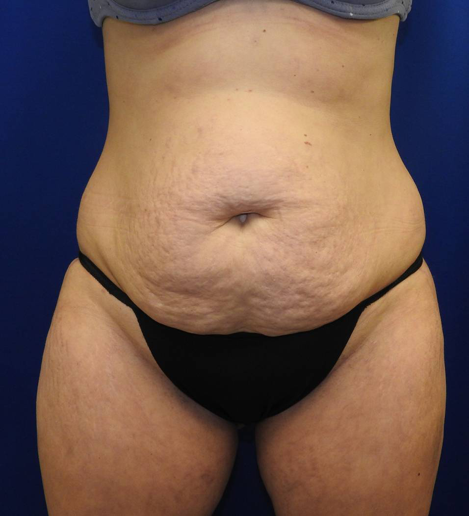 Patient 03, view 1 view before tummy tuck