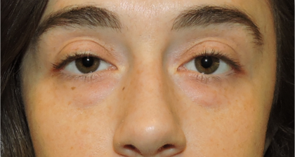 Patient 04, view 1 view before blepharoplasty