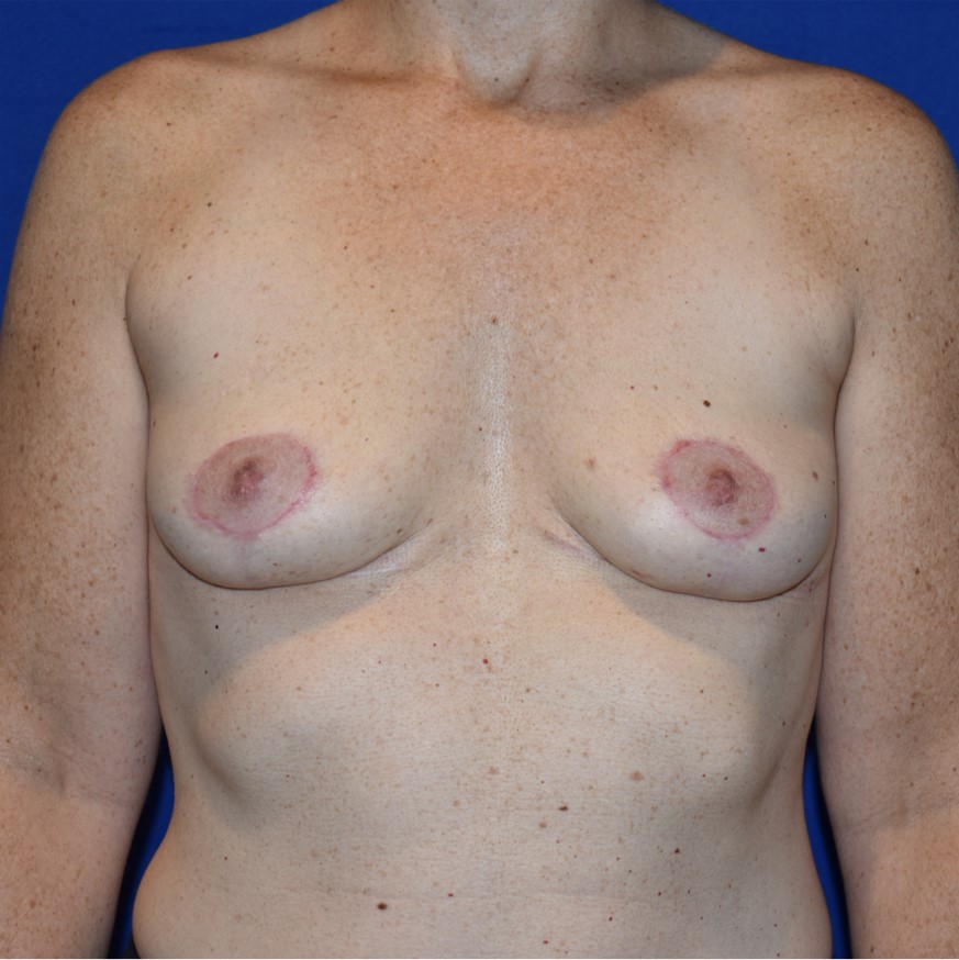 Patient 06, view 1 view after implant removal