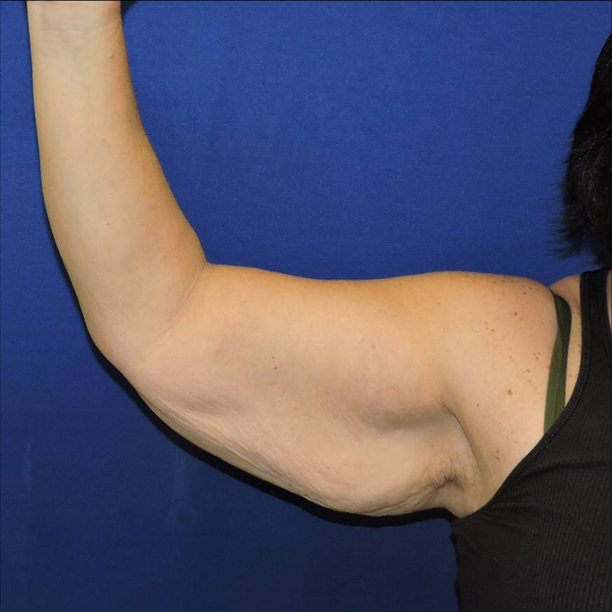 Patient 06, view 1 view before arm lift