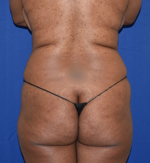 Patient 13, view 1 view before brazilian butt lift