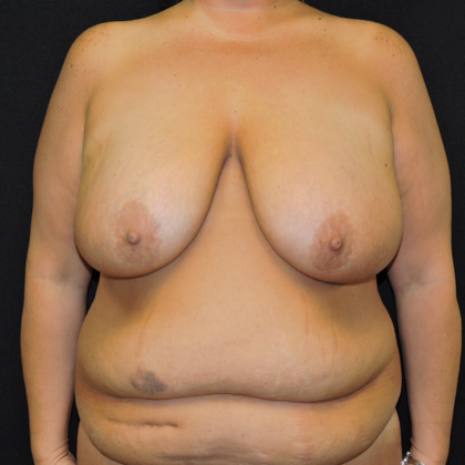 Patient 03, view 1 view before breast reduction