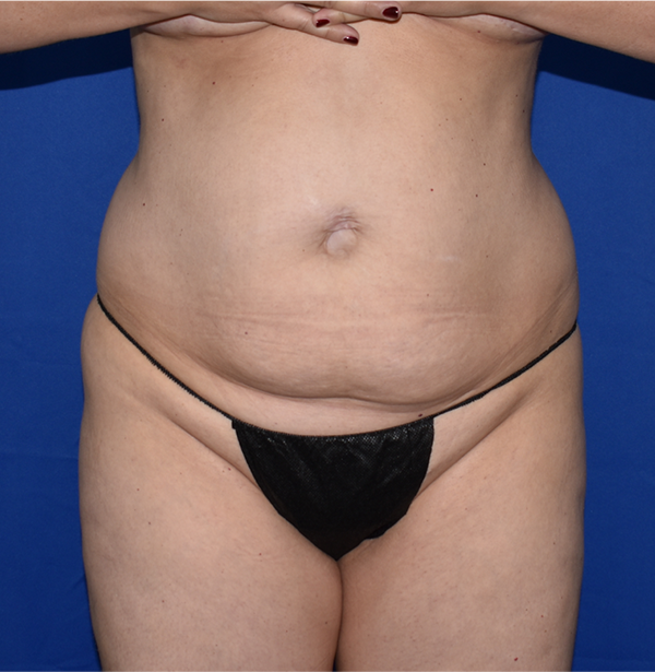 Patient 45, view 1 view before tummy tuck