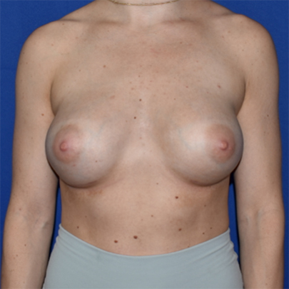 Patient 51, view 1 view after breast augmentation