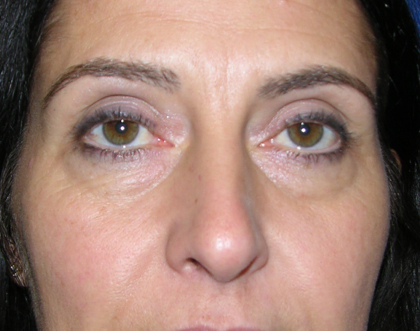 Patient 18, view 1 view before blepharoplasty