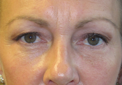 Patient 16, view 1 view after blepharoplasty