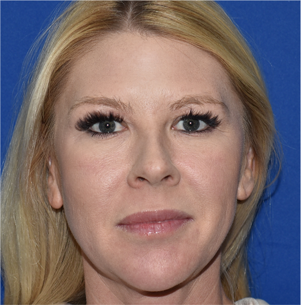 Patient 11, view 1 view before blepharoplasty