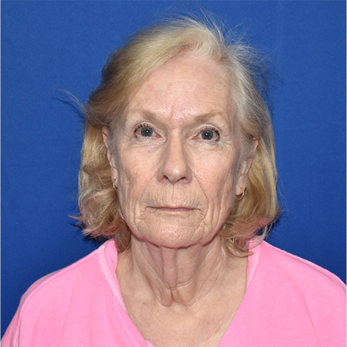 Patient 16, view 1 view before facelift