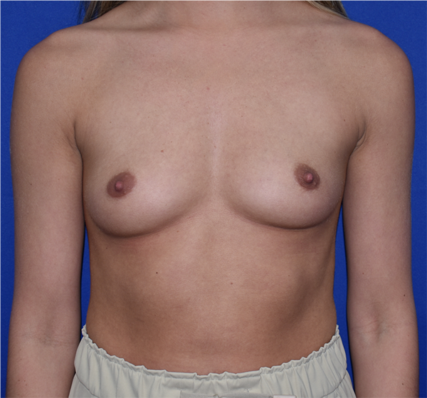 Patient 08, view 1 view before mini breast augmentation