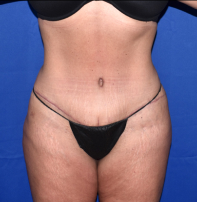 Patient 38, view 1 view after tummy tuck