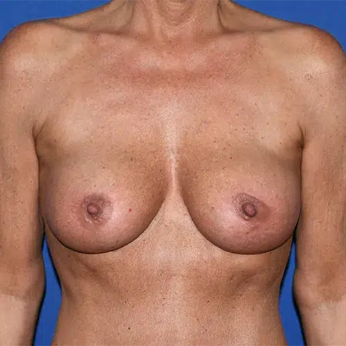 Patient 08, front view after breast augmentation with lift