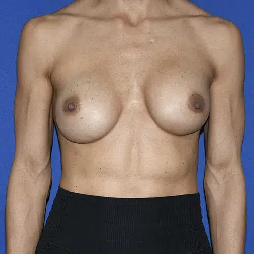 Patient 09, front view before breast implant revision