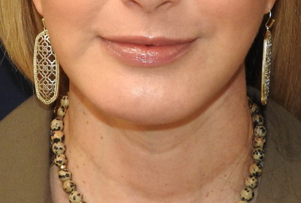 Patient 04, view 1 view after chin augmentation