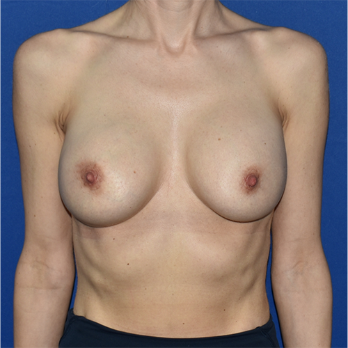 Patient 130, view 1 view before breast augmentation