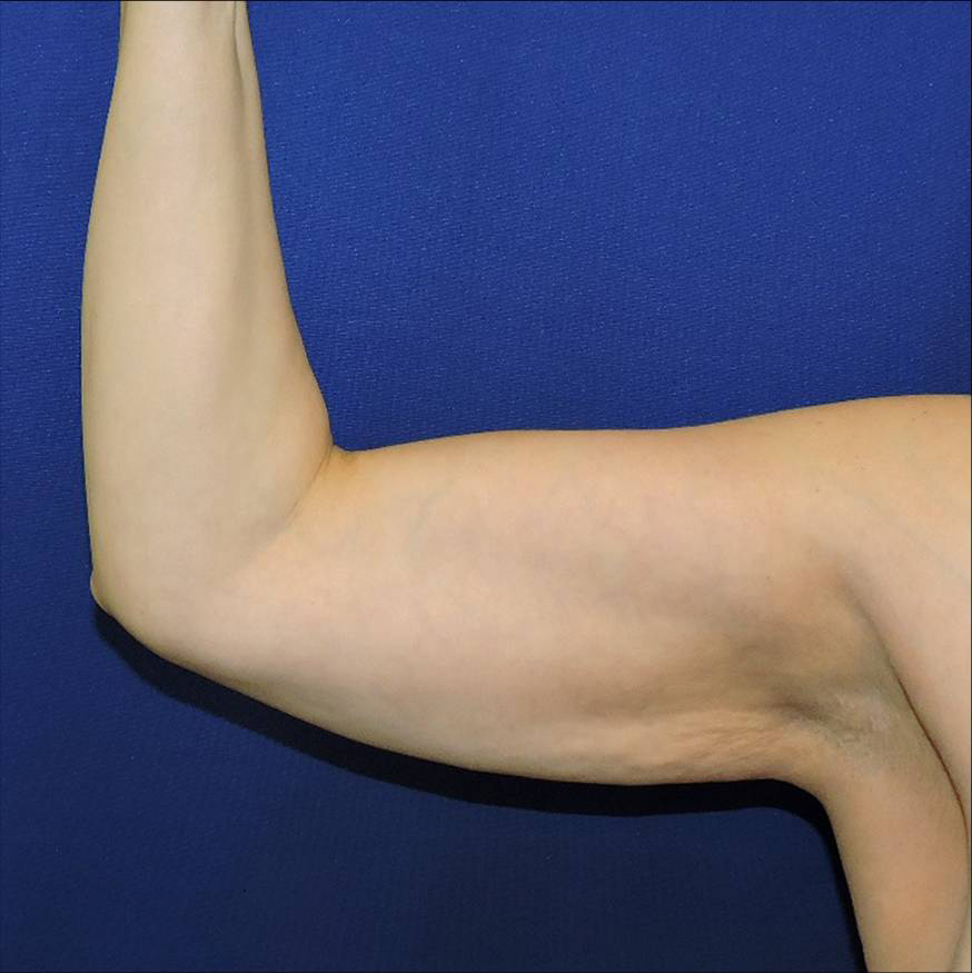 Patient 04, view 1 view before arm lift